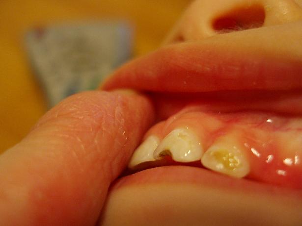 2 １歳児の虫歯治療