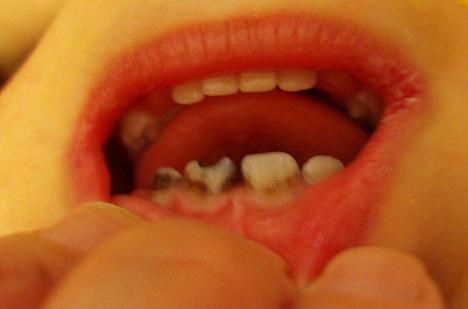 ６月２６日 １歳児の虫歯治療